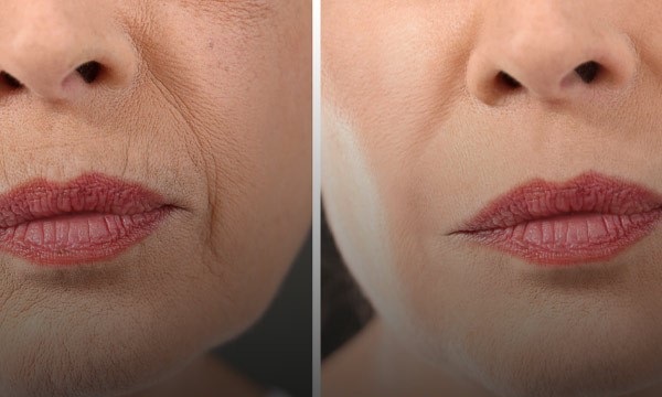 رفع لک و چین و چروک پوست با LDM | جوانسازی ایمن و طبیعی پوست